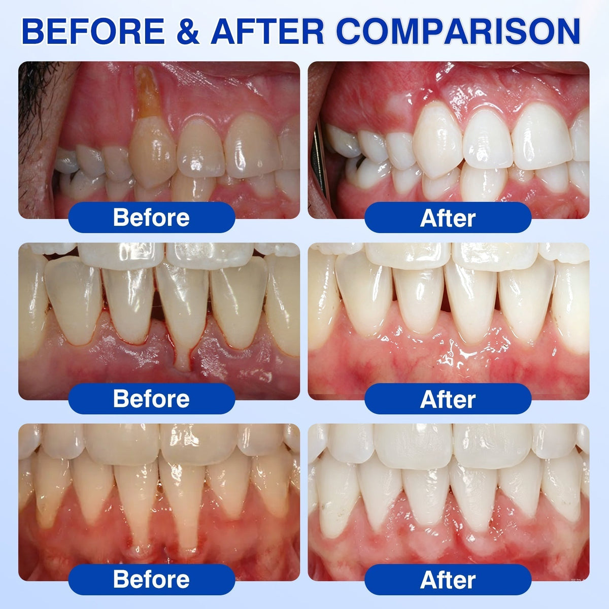 𝐇𝐈𝐒𝐊𝐈𝐍®👩‍⚕️🇿🇦🏅🦷🛡️ HISKIN® GumRevive Periodontal Repair Gel